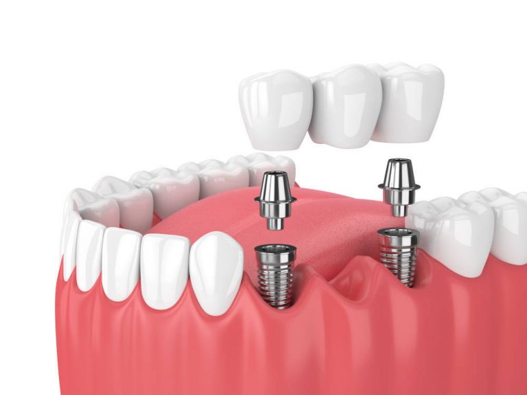 Implante dental, una excelente alternativa
